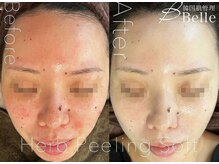 ベル 代々木店(Belle)/ニキビケア施術例