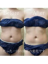 介正鍼灸整骨院 整体院 エフコープ大野城店/痩身エステ／ビフォーアフター