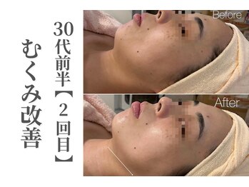 エトレ(etre)の写真/【熟練オールハンド】深部リンパ＆ツボ刺激で老廃物の排出を促進！むくみ解消で理想の韓国風小顔へ導く☆