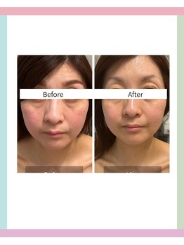 ハリスキンラボ(Hari.Skin.Lab)の写真/お顔の印象が変わる、リフトアップを叶えたい。