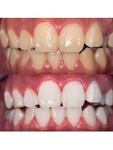 ホワイトニングビューティー 松戸店(Whitening Beauty)/ビフォーアフター