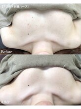 エミルカ(EMILUCA)/結婚式に向けてハーブピーリング