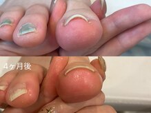 キラネイル アンド アイラッシュ by World Beauty(KIRA)/巻爪補正ペディグラス