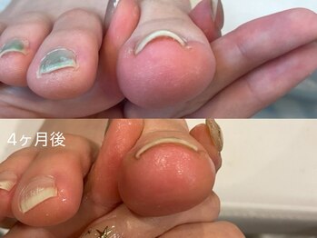 キラネイル アンド アイラッシュ by World Beauty(KIRA)/巻爪補正ペディグラス