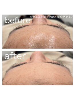 ラクシー 船橋(luxssy)/お顔シェービング