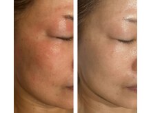 アドビューティ(Add Beauty)/≪プラズマフェイシャル≫