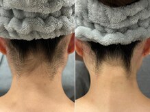 フェイシャルクレア(Cre A.)/うなじ脱毛【Mパーツ】