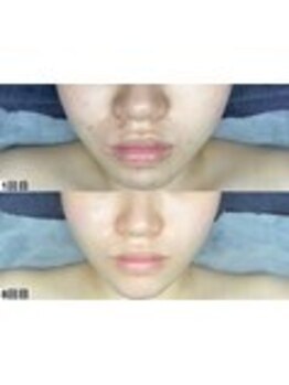 アンドミー 鹿児島中山(&me)/ララピール【艶肌/肌質改善】