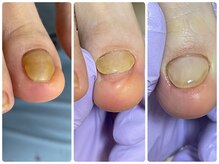 ポジ(Posi.L)の雰囲気（巻き爪補正、肥厚爪ケアもやっています！お気軽にご相談下さい）