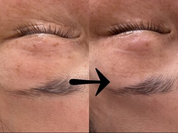 サロン ドロップ 上小田井(Salon drop)/「シミ改善」