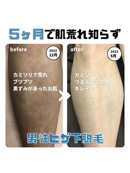 エアリアル 武雄店/メンズヒザ下脱毛!