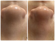 ルクシア(RUXCIA)/ビフォーアフター/毛穴洗浄1回