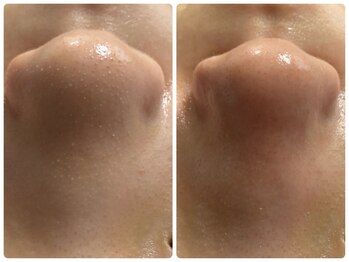 ルクシア(RUXCIA)/ビフォーアフター/毛穴洗浄1回