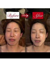 東京デトックス/1週間レチノール漬けF90分