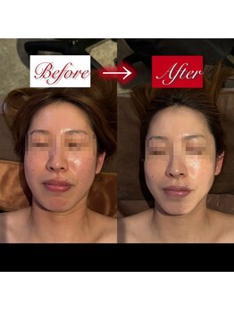 東京デトックス/1週間レチノール漬けF90分