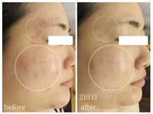 ラミーユ(La Miu)/肌質改善【二週間後の変化】