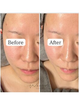 サロン ウーカ(salon WOOCA)/セラピール【毛穴開き/赤み】