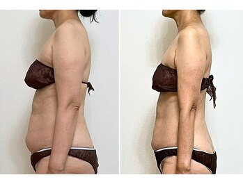 リクラ(Reclat)の写真/ノースリーブを着たいあなたへ☆憧れの華奢みえを叶える二の腕ケア♪