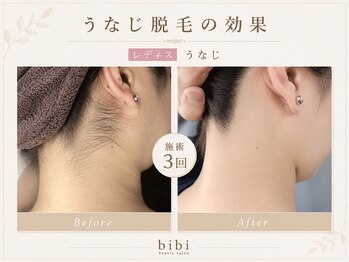 ビビ(bibi)/レディースうなじ脱毛施術3回