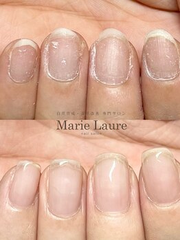 マリーロール 梅田店(Marie Laure)/自爪育成/深爪矯正/ネイルケア