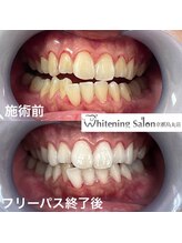 ホワイトニングサロン 京都烏丸店/ほワイトニング施術例