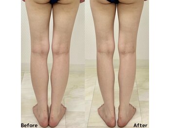 エキュロ 敦賀店(equro)/たった１回でも足の浮腫みが！