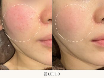 レロ 恵比寿店(LELLO)/ゴワつく肌を柔らかくフワフワに