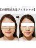 【切らないリフトアップ】小顔矯正＋光フェイシャルでニキビ、赤み改善