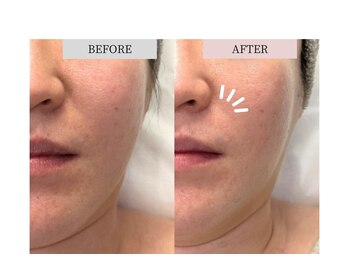 フロリール アザブジュウバン(FlorirAzabujuban)/ほうれい線/シワ改善