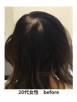 イーズ/リバイタ 梅田本店/【case9】２０代女性ビフォー