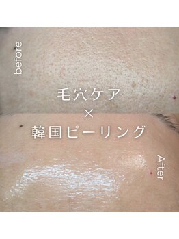 リ クリニカル ラボ(Re clinical Labo)/韓国ピーリング