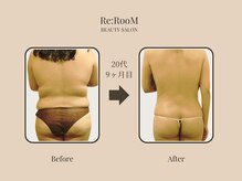 リ ルーム(Re:RooM)/痩身Before＆After