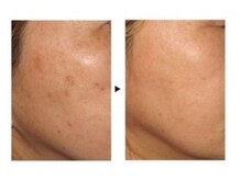 ケートータルビューティー(K. total beauty)/純粋レチノールピールエステ3