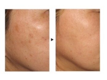 ケートータルビューティー(K. total beauty)/純粋レチノールピールエステ3