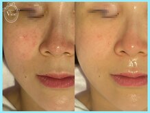 ハーブピーリング 名古屋/1度で変化が欲しい方にお勧め☆