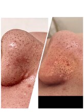 メンズ脱毛＆ヘッドスパ MEN'S with Lilina. 新横浜［ヒゲ脱毛/全身脱毛/VIO脱毛］/ハイドラ1回目　/新横浜/菊名