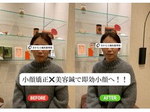 おかもと鍼灸整骨院/小顔矯正×美容鍼で即効小顔へ！
