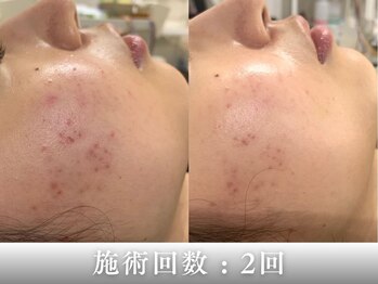 フラット(flat)の写真/毛穴の黒ずみ・ざらつき・肌荒れに◎毛穴洗浄・ハイドロピーリング×美容鍼で集中肌ケア | 初回 8800円