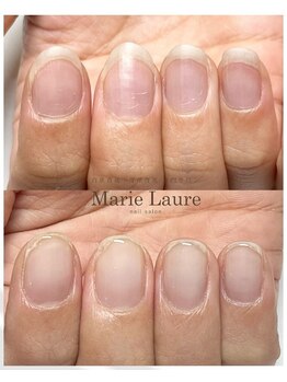 マリーロール 梅田店(Marie Laure)/自爪育成/深爪矯正/ネイルケア