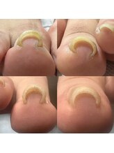 カンパニュラ(Campanula)/巻き爪ケア