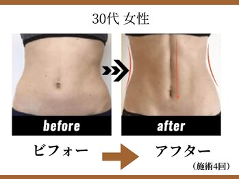 リラモ 布施本店(RELAMO)/【痩身エステ】ビフォーアフター