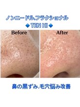 30代男性　毛穴ざらつきスッキリケア