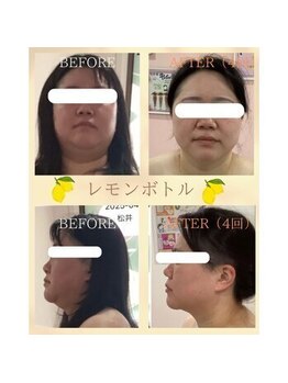 肌イズム 守谷店(肌ism)/【before&after】レモンボトル