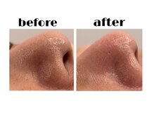 ブーティサロン(BOOTY SALON)/◇いちご鼻撃退◇