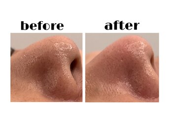 ブーティサロン(BOOTY SALON)/◇いちご鼻撃退◇