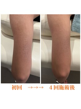 ライフ美容整体院 恵比寿(Life美容整体院)/二の腕ハーブピーリング