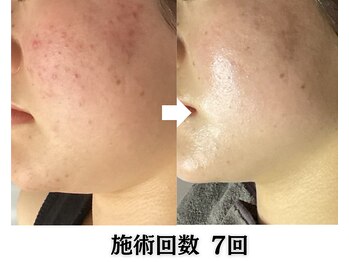 肌レボ 池袋店(肌REVO)/ハーブピーリング/ニキビケア