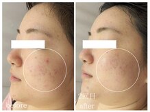 ラミーユ(La Miu)/肌質改善【二週間後の変化】