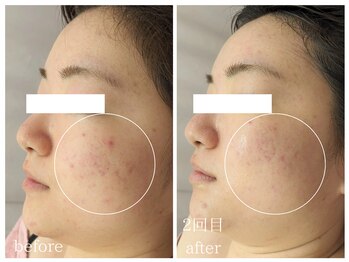 ラミーユ(La Miu)/肌質改善【二週間後の変化】