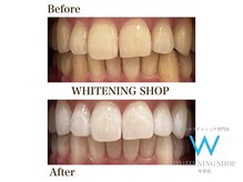 ホワイトニングショップ 甲賀店/Before&After『ホワイトニング』